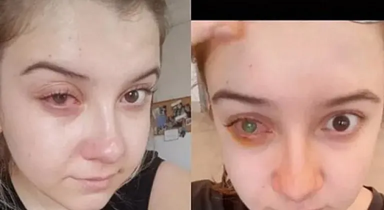 Bilinçsiz kontakt lens kullanımı göz kaybına neden olabilir